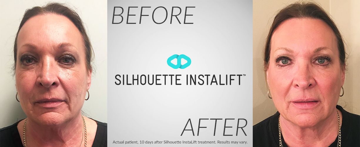 silhouette instalift before after pictures