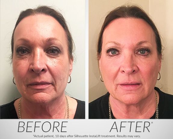 Silhouette Instalift Before and After Naples FL
