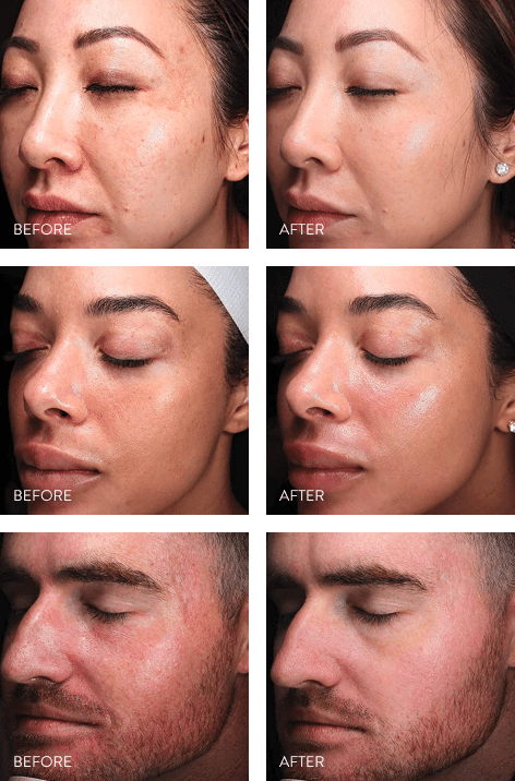BeforeAfter